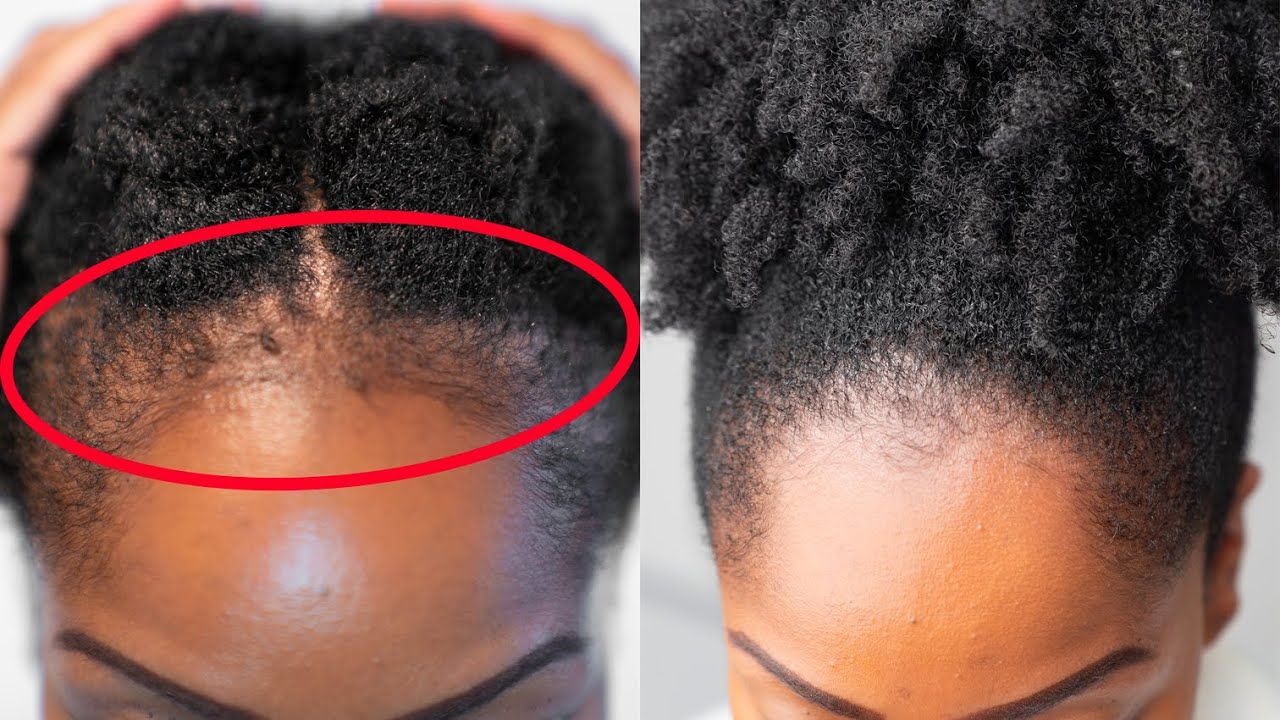 Afro Hair Transplant