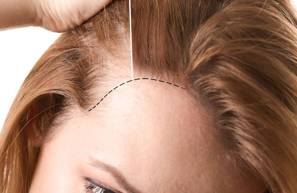 Women's Hair Transplantation
