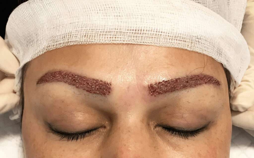 Eyebrow Transplant